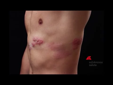 Fuoco di Sant’Antonio, rischio sottovalutato: perché informarsi e proteggersi