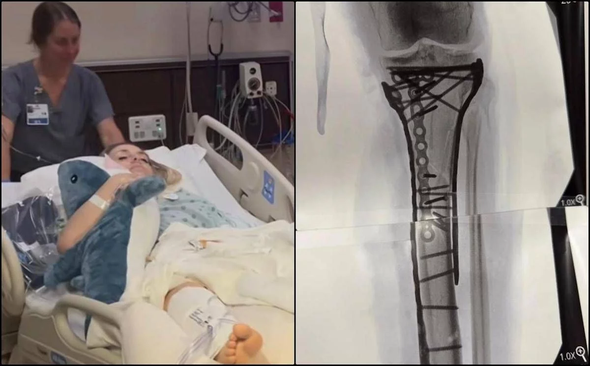 Milano Cortina, Vonn mostra la gamba dopo le operazioni: “Dolore difficile da gestire”