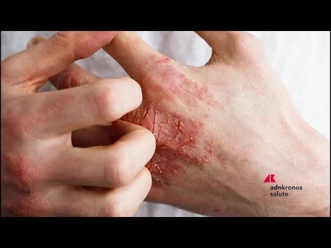 “Prendi in mano la tua vita”, al via nuova campagna su eczema cronico delle mani