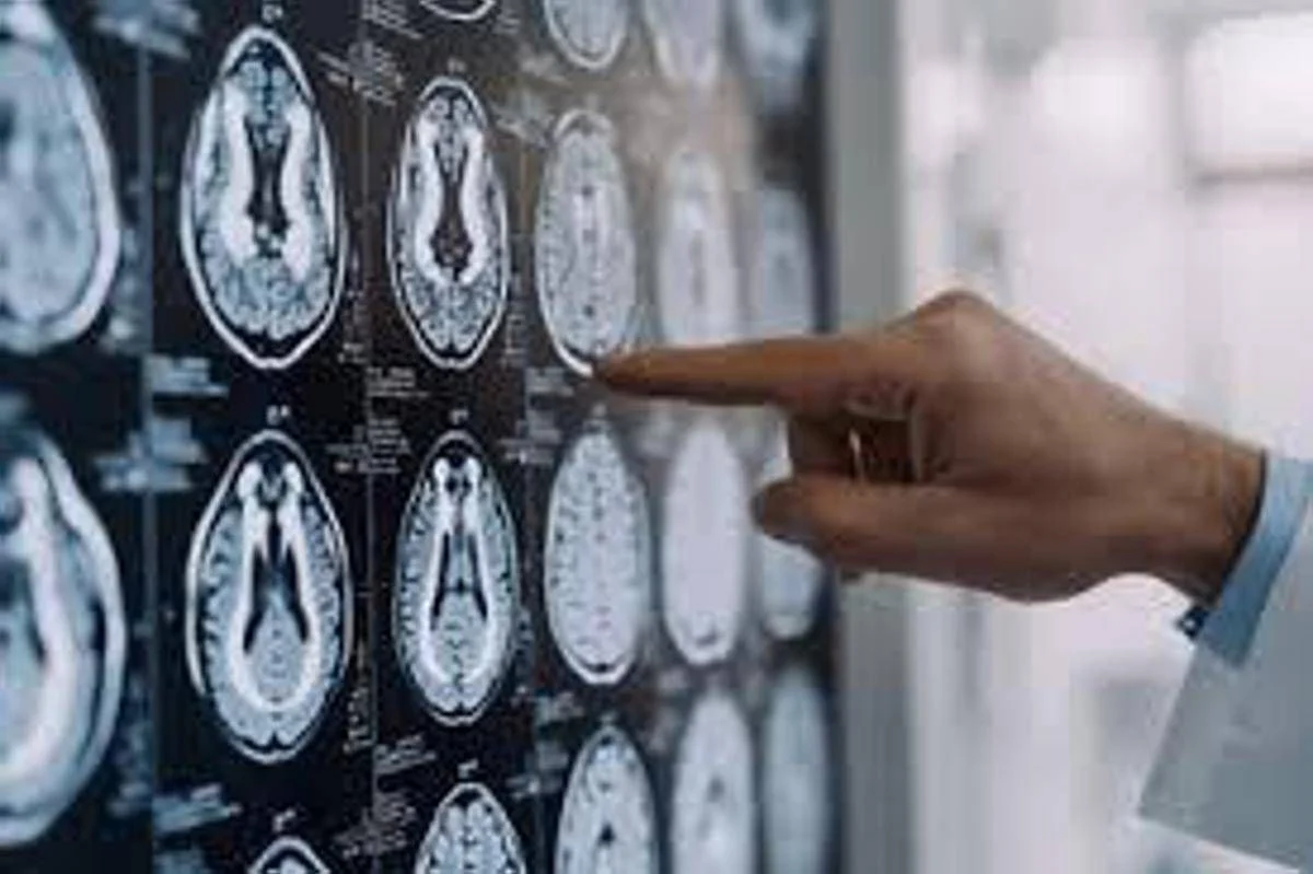 Stop tremori Parkinson senza bisturi, 10 pazienti curati con ultrasuoni a Napoli