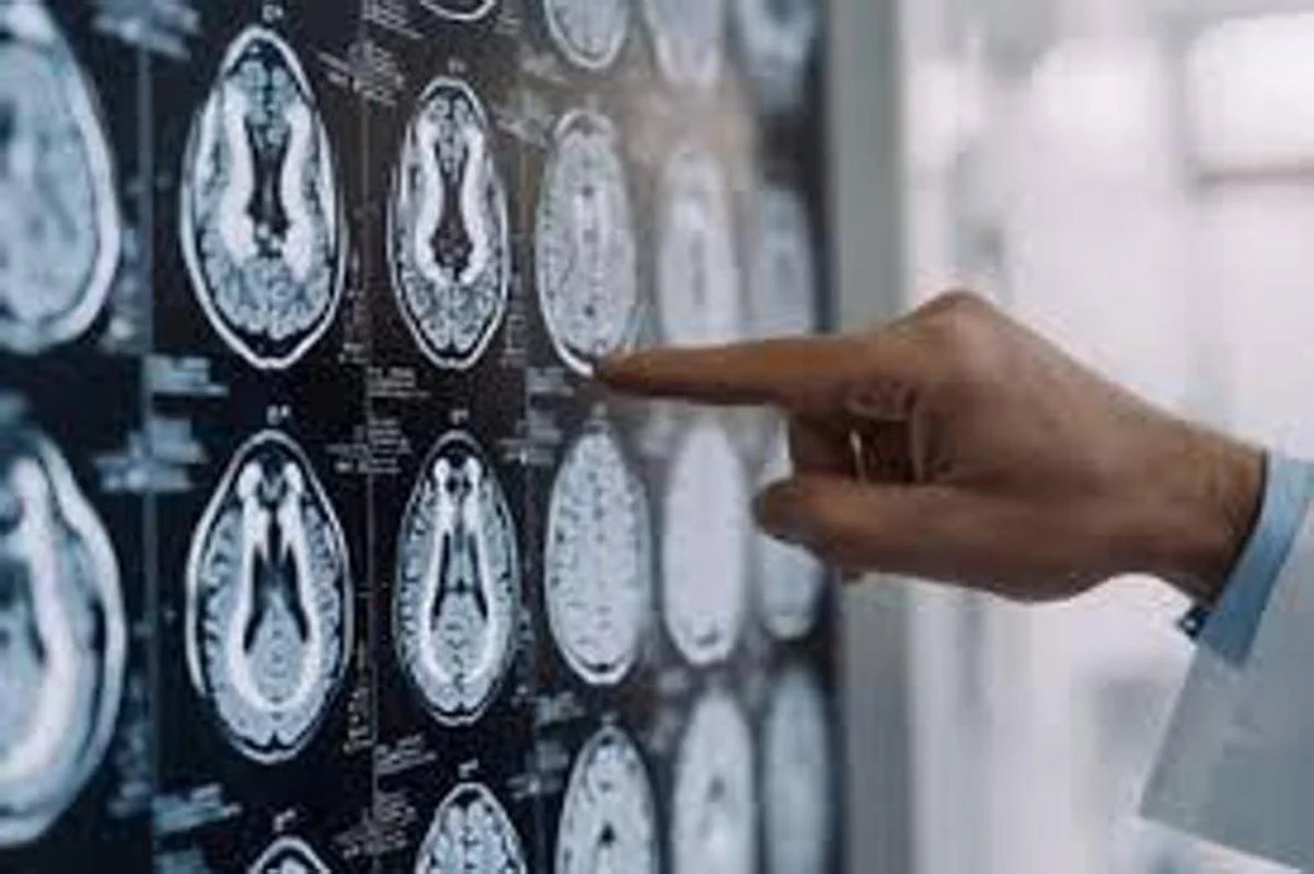 Centro Dbs Pavia, 100 interventi di neurostimolazione profonda per Parkinson