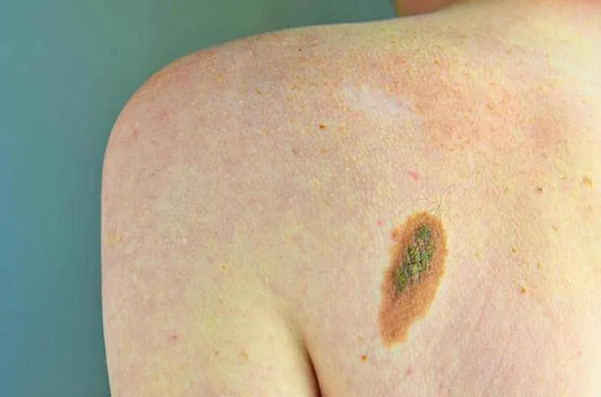 Imi: “Bene legge su prevenzione melanoma, educare i giovani su rischi”